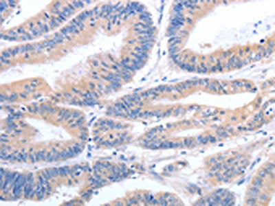 The image on the left is immunohistochemistry of paraffin-embedded Human colon cancer tissue using CSB-PA271998(GFRA4 Antibody) at dilution 1/40, on the right is treated with synthetic peptide. (Original magnification: ×200)