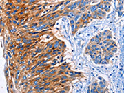 The image on the left is immunohistochemistry of paraffin-embedded Human esophagus cancer tissue using CSB-PA272000(CLEC2B Antibody) at dilution 1/50, on the right is treated with fusion protein. (Original magnification: ×200)