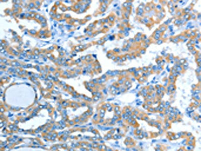 The image on the left is immunohistochemistry of paraffin-embedded Human thyroid cancer tissue using CSB-PA272345(ALDH3B1 Antibody) at dilution 1/20, on the right is treated with fusion protein. (Original magnification: ×200)