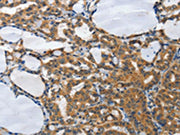 The image on the left is immunohistochemistry of paraffin-embedded Human thyroid cancer tissue using CSB-PA272603(PIAS2 Antibody) at dilution 1/70, on the right is treated with synthetic peptide. (Original magnification: ×200)