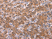 The image on the left is immunohistochemistry of paraffin-embedded Human gastic cancer tissue using CSB-PA272605(HMGCS1 Antibody) at dilution 1/40, on the right is treated with synthetic peptide. (Original magnification: ×200)