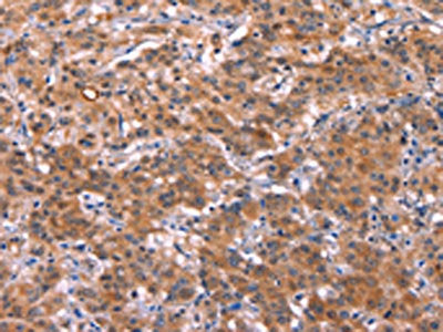 The image on the left is immunohistochemistry of paraffin-embedded Human gastic cancer tissue using CSB-PA272605(HMGCS1 Antibody) at dilution 1/40, on the right is treated with synthetic peptide. (Original magnification: ×200)