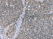 The image on the left is immunohistochemistry of paraffin-embedded Human cervical cancer tissue using CSB-PA272939(FANCG Antibody) at dilution 1/30, on the right is treated with fusion protein. (Original magnification: ×200)