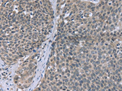 The image on the left is immunohistochemistry of paraffin-embedded Human cervical cancer tissue using CSB-PA272939(FANCG Antibody) at dilution 1/30, on the right is treated with fusion protein. (Original magnification: ×200)