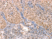 The image on the left is immunohistochemistry of paraffin-embedded Human lymphoma tissue using CSB-PA272943(PTMA Antibody) at dilution 1/25, on the right is treated with synthetic peptide. (Original magnification: ×200)