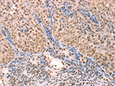 The image on the left is immunohistochemistry of paraffin-embedded Human lymphoma tissue using CSB-PA272943(PTMA Antibody) at dilution 1/25, on the right is treated with synthetic peptide. (Original magnification: ×200)