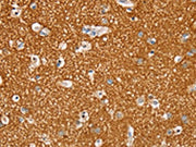 The image on the left is immunohistochemistry of paraffin-embedded Human brain tissue using CSB-PA273062(STK32A Antibody) at dilution 1/30, on the right is treated with synthetic peptide. (Original magnification: ×200)