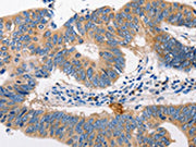 The image on the left is immunohistochemistry of paraffin-embedded Human colon cancer tissue using CSB-PA273227(MTOR Antibody) at dilution 1/60, on the right is treated with synthetic peptide. (Original magnification: ×200)