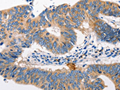 The image on the left is immunohistochemistry of paraffin-embedded Human colon cancer tissue using CSB-PA273227(MTOR Antibody) at dilution 1/60, on the right is treated with synthetic peptide. (Original magnification: ×200)