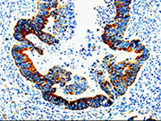The image on the left is immunohistochemistry of paraffin-embedded Human rectal cancer tissue using CSB-PA273292(IL23R Antibody) at dilution 1/10, on the right is treated with fusion protein. (Original magnification: ×200)