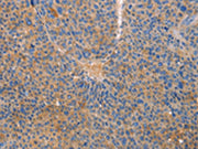 The image on the left is immunohistochemistry of paraffin-embedded Human liver cancer tissue using CSB-PA273344(CXCL3 Antibody) at dilution 1/20, on the right is treated with fusion protein. (Original magnification: ×200)