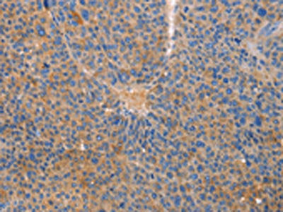 The image on the left is immunohistochemistry of paraffin-embedded Human liver cancer tissue using CSB-PA273344(CXCL3 Antibody) at dilution 1/20, on the right is treated with fusion protein. (Original magnification: ×200)