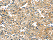 The image on the left is immunohistochemistry of paraffin-embedded Human liver cancer tissue using CSB-PA273438(TMPRSS4 Antibody) at dilution 1/50, on the right is treated with fusion protein. (Original magnification: ×200)