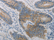 The image on the left is immunohistochemistry of paraffin-embedded Human colon cancer tissue using CSB-PA273524(CLEC4C Antibody) at dilution 1/50, on the right is treated with synthetic peptide. (Original magnification: ×200)