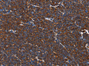 The image on the left is immunohistochemistry of paraffin-embedded Human lymphoma tissue using CSB-PA273685(PLK3 Antibody) at dilution 1/40, on the right is treated with fusion protein. (Original magnification: ×200)