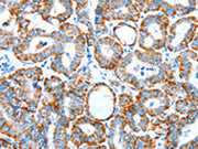 The image on the left is immunohistochemistry of paraffin-embedded Human thyroid cancer tissue using CSB-PA273719(ALDH5A1 Antibody) at dilution 1/60, on the right is treated with synthetic peptide. (Original magnification: ×200)