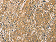 The image on the left is immunohistochemistry of paraffin-embedded Human gastic cancer tissue using CSB-PA273741(SNAP91 Antibody) at dilution 1/20, on the right is treated with fusion protein. (Original magnification: ×200)