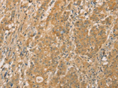 The image on the left is immunohistochemistry of paraffin-embedded Human gastic cancer tissue using CSB-PA273741(SNAP91 Antibody) at dilution 1/20, on the right is treated with fusion protein. (Original magnification: ×200)