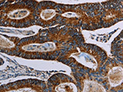 The image on the left is immunohistochemistry of paraffin-embedded Human colon cancer tissue using CSB-PA273795(NDUFA4 Antibody) at dilution 1/40, on the right is treated with synthetic peptide. (Original magnification: ×200)