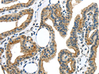 The image on the left is immunohistochemistry of paraffin-embedded Human thyroid cancer tissue using CSB-PA273818(VAMP2 Antibody) at dilution 1/40, on the right is treated with synthetic peptide. (Original magnification: ×200)