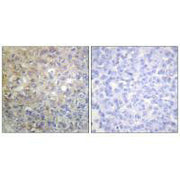 Immunohistochemistry analysis of paraffin-embedded human breast carcinoma tissue using FGFR1 (Ab-766) antiobdy.