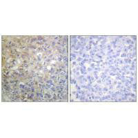 Immunohistochemistry analysis of paraffin-embedded human breast carcinoma tissue using FGFR1 (Ab-766) antiobdy.