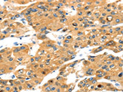 The image on the left is immunohistochemistry of paraffin-embedded Human liver cancer tissue using CSB-PA273921(TBX18 Antibody) at dilution 1/20, on the right is treated with fusion protein. (Original magnification: ×200)