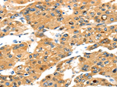 The image on the left is immunohistochemistry of paraffin-embedded Human liver cancer tissue using CSB-PA273921(TBX18 Antibody) at dilution 1/20, on the right is treated with fusion protein. (Original magnification: ×200)