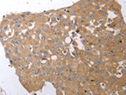The image on the left is immunohistochemistry of paraffin-embedded Human breast cancer tissue using CSB-PA273939(SIRT5 Antibody) at dilution 1/25, on the right is treated with synthetic peptide. (Original magnification: ×200)