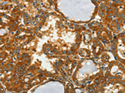 The image on the left is immunohistochemistry of paraffin-embedded Human thyroid cancer tissue using CSB-PA274065(GOT1 Antibody) at dilution 1/50, on the right is treated with fusion protein. (Original magnification: ×200)