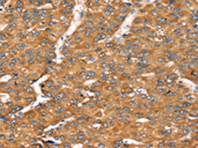 The image on the left is immunohistochemistry of paraffin-embedded Human liver cancer tissue using CSB-PA274133(TGFB2 Antibody) at dilution 1/20, on the right is treated with synthetic peptide. (Original magnification: ×200)