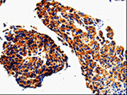 The image on the left is immunohistochemistry of paraffin-embedded Human lung cancer tissue using CSB-PA274173(ADD1 Antibody) at dilution 1/50, on the right is treated with fusion protein. (Original magnification: ×200)