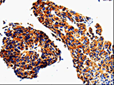 The image on the left is immunohistochemistry of paraffin-embedded Human lung cancer tissue using CSB-PA274173(ADD1 Antibody) at dilution 1/50, on the right is treated with fusion protein. (Original magnification: ×200)