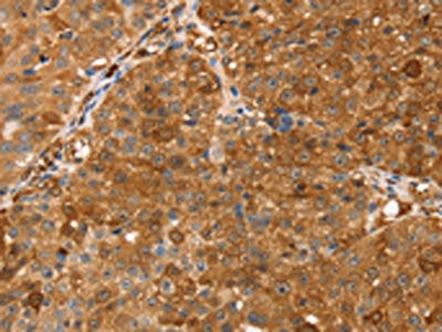 The image on the left is immunohistochemistry of paraffin-embedded Human breast cancer tissue using CSB-PA274264(TMSB10 Antibody) at dilution 1/35, on the right is treated with synthetic peptide. (Original magnification: ×200)