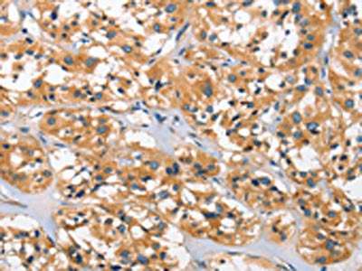 The image on the left is immunohistochemistry of paraffin-embedded Human thyroid cancer tissue using CSB-PA274333(DKK3 Antibody) at dilution 1/30, on the right is treated with fusion protein. (Original magnification: ×200)