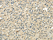 The image on the left is immunohistochemistry of paraffin-embedded Human prostate cancer tissue using CSB-PA274411(USP1 Antibody) at dilution 1/25, on the right is treated with fusion protein. (Original magnification: ×200)