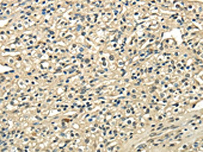 The image on the left is immunohistochemistry of paraffin-embedded Human prostate cancer tissue using CSB-PA274411(USP1 Antibody) at dilution 1/25, on the right is treated with fusion protein. (Original magnification: ×200)