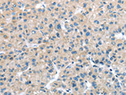 The image on the left is immunohistochemistry of paraffin-embedded Human liver cancer tissue using CSB-PA274847(ITPA Antibody) at dilution 1/25, on the right is treated with fusion protein. (Original magnification: ×200)