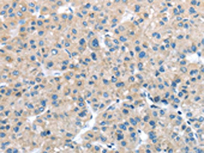 The image on the left is immunohistochemistry of paraffin-embedded Human liver cancer tissue using CSB-PA274847(ITPA Antibody) at dilution 1/25, on the right is treated with fusion protein. (Original magnification: ×200)