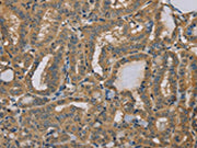 The image on the left is immunohistochemistry of paraffin-embedded Human thyroid cancer tissue using CSB-PA274859(MYL3 Antibody) at dilution 1/40, on the right is treated with fusion protein. (Original magnification: ×200)