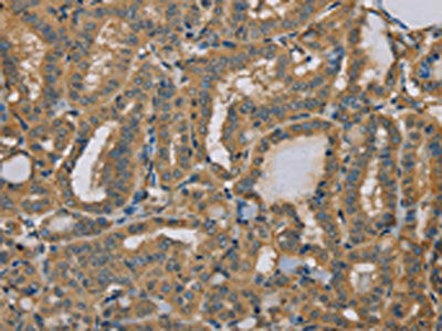 The image on the left is immunohistochemistry of paraffin-embedded Human thyroid cancer tissue using CSB-PA274859(MYL3 Antibody) at dilution 1/40, on the right is treated with fusion protein. (Original magnification: ×200)