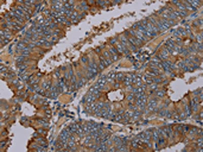 The image on the left is immunohistochemistry of paraffin-embedded Human colon cancer tissue using CSB-PA274876(PYY Antibody) at dilution 1/30, on the right is treated with synthetic peptide. (Original magnification: ×200)