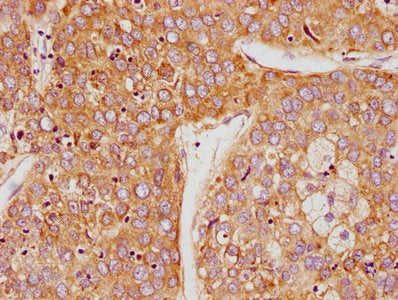 IHC image of CSB-PA27499A0Rb diluted at 1:100 and staining in paraffin-embedded human liver cancer performed on a Leica BondTM system. After dewaxing and hydration, antigen retrieval was mediated by high pressure in a citrate buffer (pH 6.0). Sect...