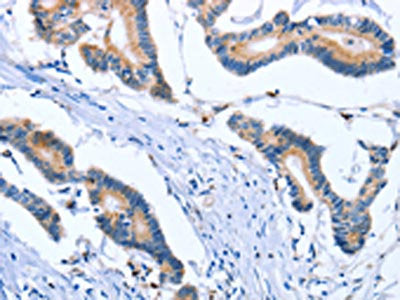 The image on the left is immunohistochemistry of paraffin-embedded Human colon cancer tissue using CSB-PA275027(PLK3 Antibody) at dilution 1/30, on the right is treated with fusion protein. (Original magnification: ×200)