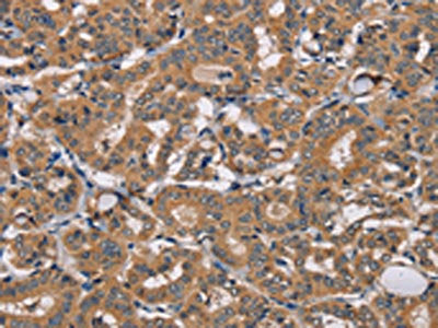 The image on the left is immunohistochemistry of paraffin-embedded Human thyroid cancer tissue using CSB-PA275058(TRAFD1 Antibody) at dilution 1/20, on the right is treated with fusion protein. (Original magnification: ×200)