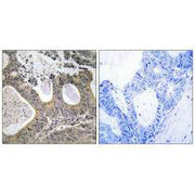 Immunohistochemistry analysis of paraffin-embedded human colon carcinoma tissue, using STEA2 antibody.