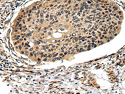 The image on the left is immunohistochemistry of paraffin-embedded Human esophagus cancer tissue using CSB-PA275426(FOXK1 Antibody) at dilution 1/20, on the right is treated with synthetic peptide. (Original magnification: ×200)