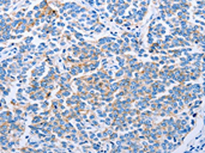 The image on the left is immunohistochemistry of paraffin-embedded Human breast cancer tissue using CSB-PA275606(CLDN4 Antibody) at dilution 1/50, on the right is treated with synthetic peptide. (Original magnification: ×200)