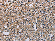 The image on the left is immunohistochemistry of paraffin-embedded Human prostate cancer tissue using CSB-PA275832(PNPT1 Antibody) at dilution 1/40, on the right is treated with synthetic peptide. (Original magnification: ×200)