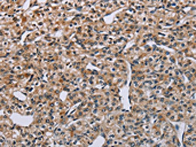The image on the left is immunohistochemistry of paraffin-embedded Human prostate cancer tissue using CSB-PA275832(PNPT1 Antibody) at dilution 1/40, on the right is treated with synthetic peptide. (Original magnification: ×200)